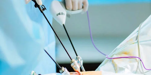 Detailed image showing the process of Laparoscopy
